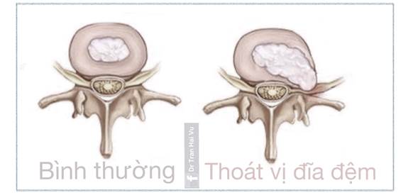 Thoát vị đĩa đệm là gì?  