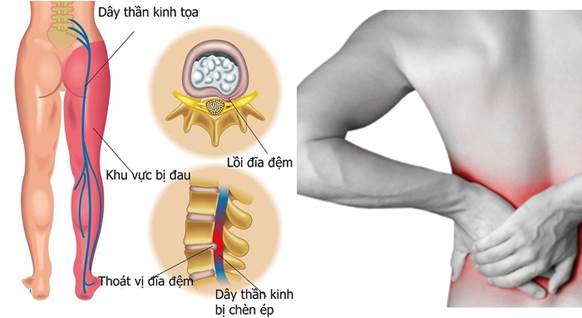 Các dấu hiệu nào nghỉ ngờ bị thoát vị đĩa đệm?